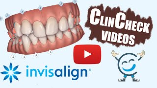 Invisalign ClinCheck Videos For Various Teeth Conditions [upl. by Morrill336]