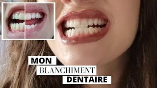 BLANCHIMENT DENTAIRE  chez le dentiste  prix durée etc JE VOUS DIS TOUT [upl. by Corkhill]