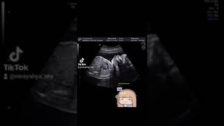 Baby hiccup at 28 weeks pregnancy [upl. by Jordans]