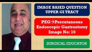 PERCUTANEOUS ENDOSCOPIC GASTROSTOMY UPPER GI TRACT Image Based Question [upl. by Nednerb]