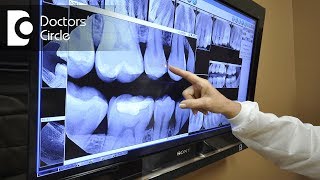 How safe are dental x rays  Dr Shyam Padmanabhan [upl. by Glad346]