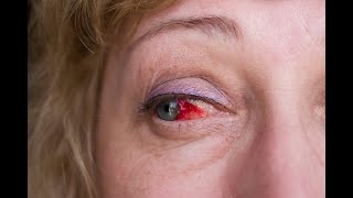 Subconjunctival Hemorrhage  Causes Signs amp Symptoms Treatment [upl. by Vatsug]