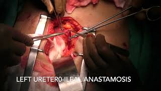 Extracorporeal ileal conduit after Laparoscopic Radical cystectomy for MIBC [upl. by Jimmy]