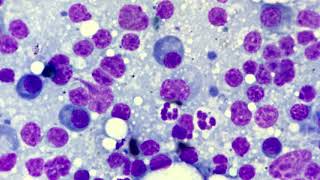 Reactive Lymphadenitis cytology [upl. by Cuttie]