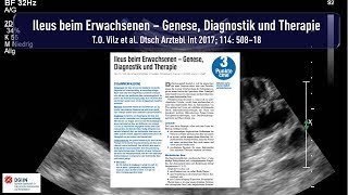 Ileus beim Erwachsenen [upl. by Ahsote]