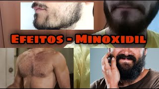 EFEITOS COLATERAIS MINOXIDIL  EFEITO SHEDDING E O CRESCIMENTO DE PELOS EM OUTRAS PARTES DO CORPO 😨 [upl. by Ezar538]