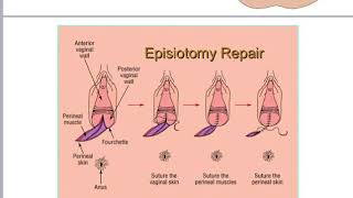 Episiotomy [upl. by Ninon]