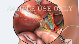 Gallbladder Removal Surgery Laparoscopic Cholecystectomy [upl. by Oinolopa]