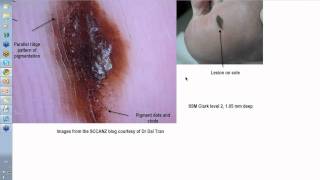 Dermoscopy Made Simple  Acral and Subungual Melanoma [upl. by Yeoj]