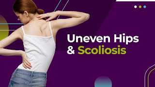 Uneven Hips and Scoliosis [upl. by Noinatrad]