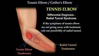 Tennis Elbow  Golfers Elbow  Anatomy amp Treatment [upl. by Adyahs]