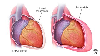 How to differentiate between pericardial and pleural friction rub  MEDINCINE with DR SHAMAMA [upl. by Ttsepmet]