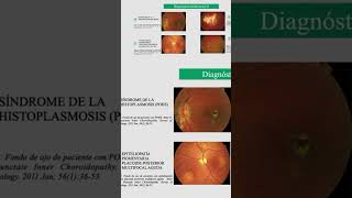 Síndrome de la Histoplasmosis Ocular [upl. by Nahem347]