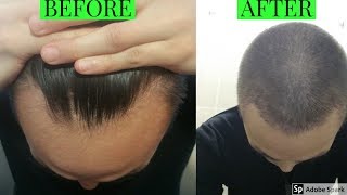 FINASTERIDE PROPECIA ONE YEAR UPDATE [upl. by Ahs]