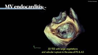 〖Echocardiography〗 Mitral valve endocarditis with rupture of the MV 🫀 [upl. by Gnem62]