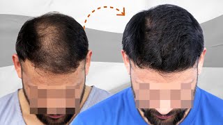 Grade 5 Baldness GONE 💥 Hair Transplant Results in Bangladesh  New Roots [upl. by Adaline]