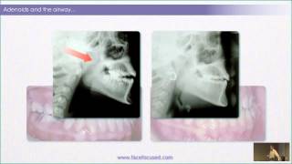 The Case for Rewards of Correcting Rest Oral Posture  William M Hang DDS MSD [upl. by Desmond]