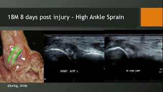 Ultrasound High Ankle Sprain Part 3 Tutorial [upl. by Aserehc358]