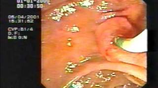 Endoscopy Master Videos ERCP Cannulation amp sphincterotomy  wwwgastrolivercomsg [upl. by Danice]