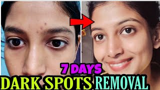 Real Experience 😍 Dark Spots Treatment Naturally at home [upl. by Anaeirb526]