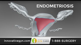 Treating Endometriosis Successfully Takes a Skilled GYN Surgeon [upl. by Kelsi771]