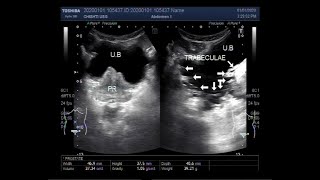 Ultrasound Video showing enlarged Prostate with trabeculated urinary bladder [upl. by Kellyann]