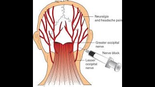 Occipital Nerve Block [upl. by Trinatte566]