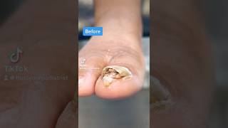 Onychomycosis podiatry fungaltoenail [upl. by Dorina583]