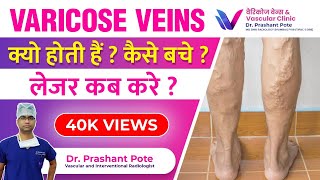 Varicose veins causes and treatment I Dr Prashant Pote explaining on TV channel INH NEWS [upl. by Vonnie]