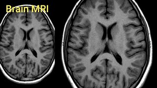 Normal BRAIN MRI image [upl. by Caruso503]