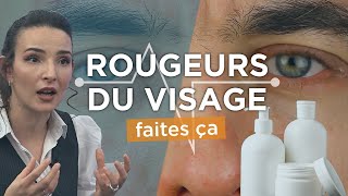 ROUGEURS autour des sourcils du nez Voila comment SOIGNER la dermite seborrhéique [upl. by Apfel488]