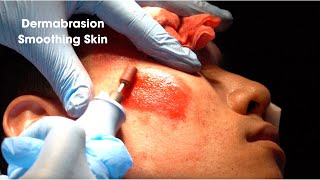 Dermabrasion Smoothing Acne Scar Skin [upl. by Seuguh44]