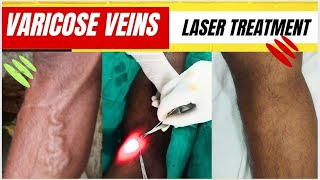 Laser treatment of varicose veins SSC GD medical  Varicose veins treatment Varicose vein laser [upl. by Ydoc]