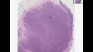 Histopathology ColonBurkitt lymphoma [upl. by Sirapal156]