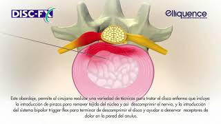 TRATAMIENTO DE HERNIAS DISCALES POR NUCLEOPLASTIA CON DISCFX [upl. by Adlesirhc]