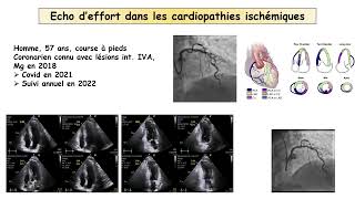 Sportif asymptomatique avec cardiopathie VO2 contre écho d’effort que choisir [upl. by Malcolm414]