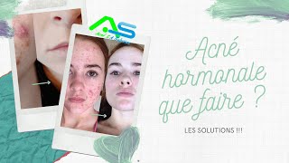 Acné hormonale que faire  Les solutions [upl. by Nanette750]