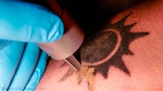 How Laser Tattoo Removal Works  Smarter Every Day 123 [upl. by Sitoiganap]