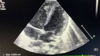 Partial AV septal Defect with Ostium Secundum ASD [upl. by Haldi94]