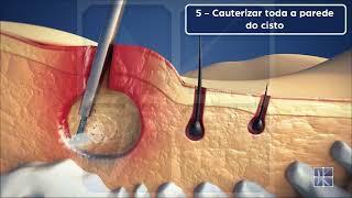 EPSIT Endoscopic Pilonidal Sinus Treatment  Tratamento Endoscópico do Cisto Pilonidal [upl. by Hamish253]