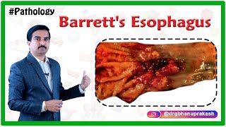 Barretts esophagus Pathology Lecture  Usmle Quick review  Dr Bhanu prakash [upl. by Rednazxela376]