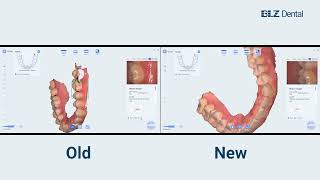 Scanning Performance of Intraoral Scanner New Software V2310002 Compared to Previous Version [upl. by Enialedam778]