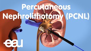 Removal of kidney stones PCNL [upl. by Greenwald]