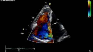 HUGE TRICUSPID REGURGITATION [upl. by Stent]