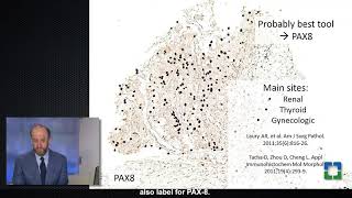 Diagnosis of Metastatic Renal Cancer with Sean Williamson MD [upl. by Ayortal686]