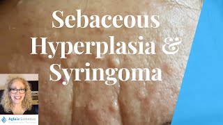 SEBACEOUS HYPERPLASIA VS SYRINGOMA  BEST REMOVAL PROCEDURES [upl. by Aken]