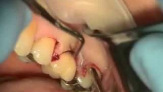 Periodontal Endoscopy and Microsurgery Implant Repair [upl. by Anirehs]