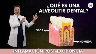 ALVEOLITIS dental Causas y tratamiento🦷 [upl. by Ynnaej612]