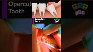 Operculum wisdom tooth treatment dentist dentistry wisdomtooth shortsfeed [upl. by Jeanne]