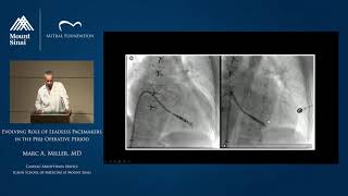 Evolving Role of Leadless Pacemakers in the Perioperative Period [upl. by Conrad45]